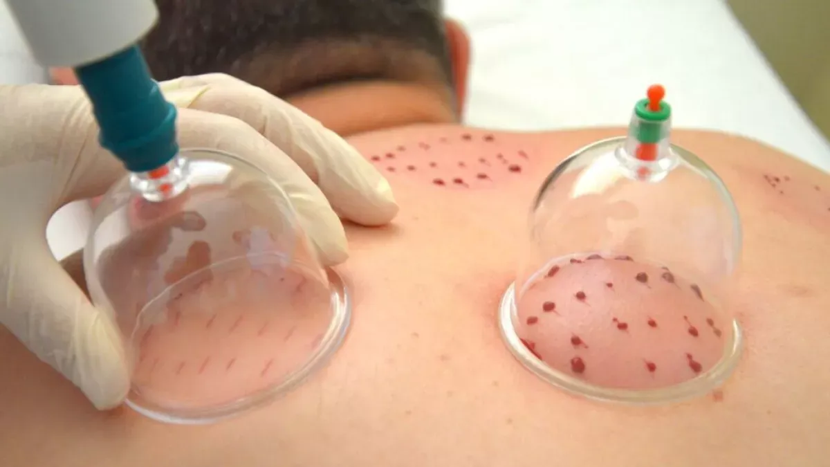 Hacamat Neden Klinik Ortamda Yapılmalı? Faydaları ve Riskleri